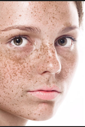Hyperpigmentation-Natural ways to have a glowing skin.