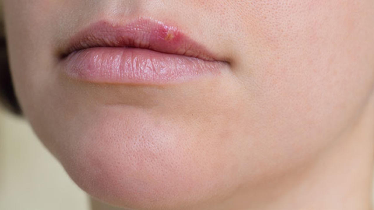 Cold Sore Bothering your? Use Hydrogen Peroxide for Cold Sores